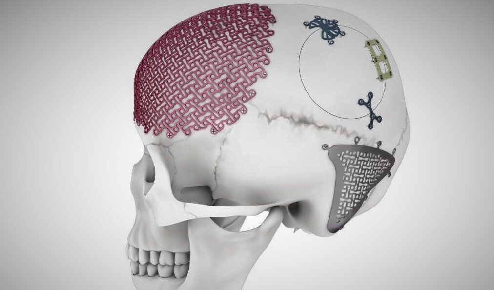 Craniomaxillofacial Devices Market