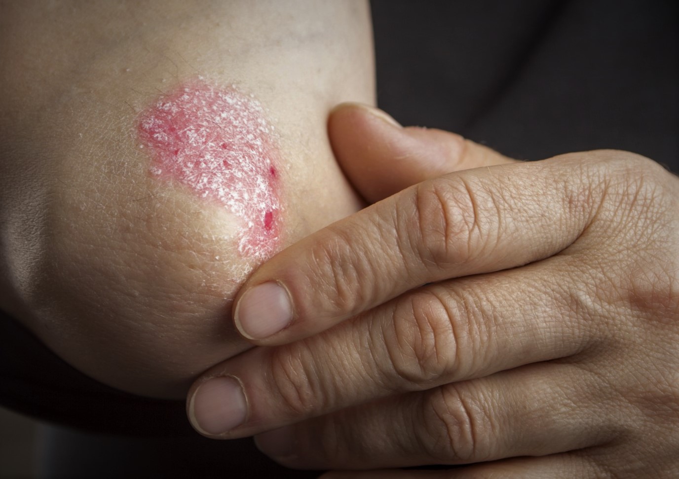 Psoriasis Treatment Market Size, Share, Growth & Analysis Report 2026