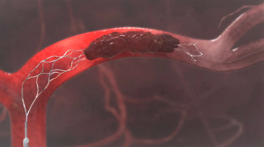 Mechanical Thrombectomy Devices Market – A Revolutionary Treatment for Blood Clots
