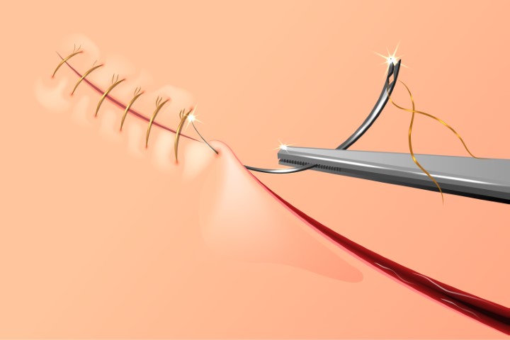 Surgical Sutures Market Size, Industry Trends, Demands and Forecast 2023 to 2027