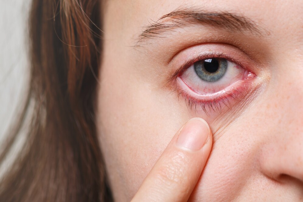 Dry Eye Syndrome Treatment Market: Population Health and Industry Growth Analysis for Forecast to 2027