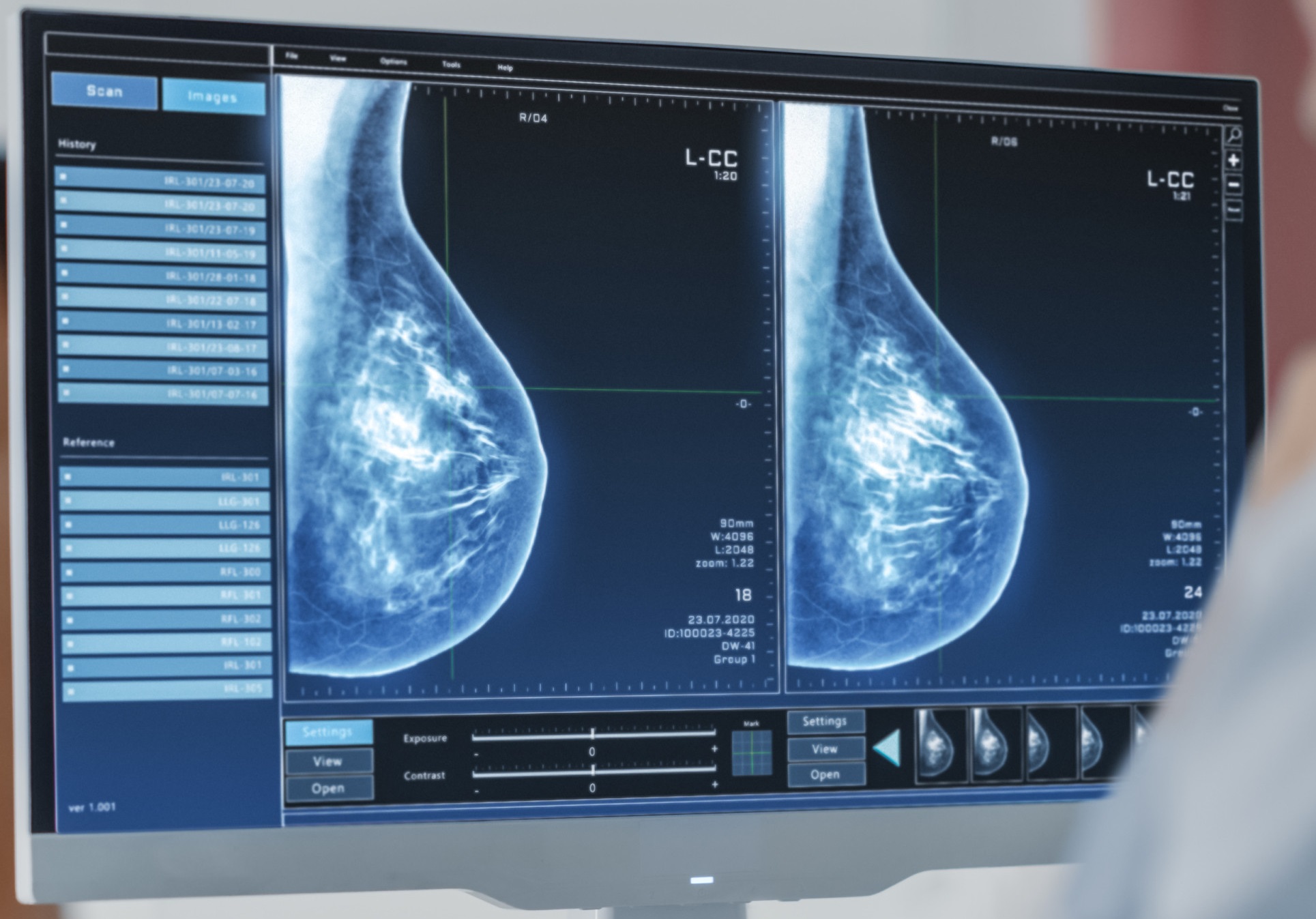 Breast Imaging Market Size: Investment Surge and Technological Breakthroughs from 2023 to 2028