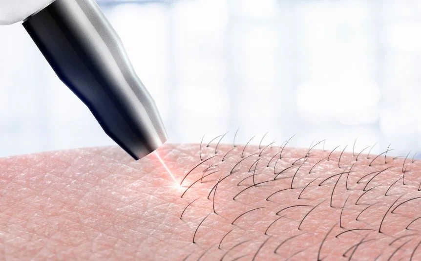 Laser Hair Removal Market Size, Growth, Share, Industry Strategic Innovations, and Forecast to 2023