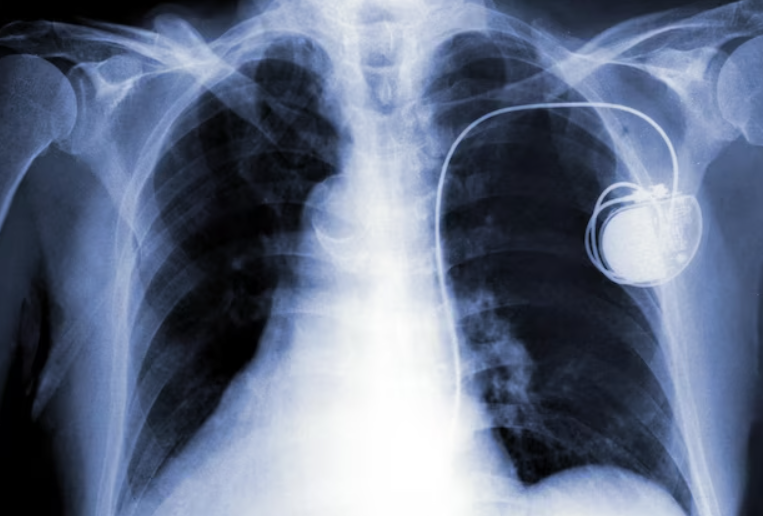 Pacemakers Market – Global Industry Analysis, Share, Market Growth and Forecast to 2028