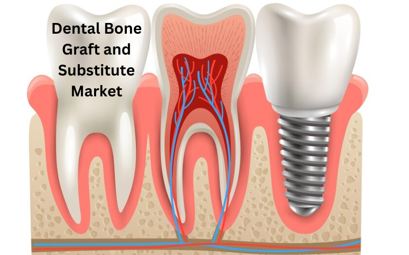 Insights into the Global Dental Bone Graft & Substitute Market: Growth Projections and Market Drivers from 2024 to 2029