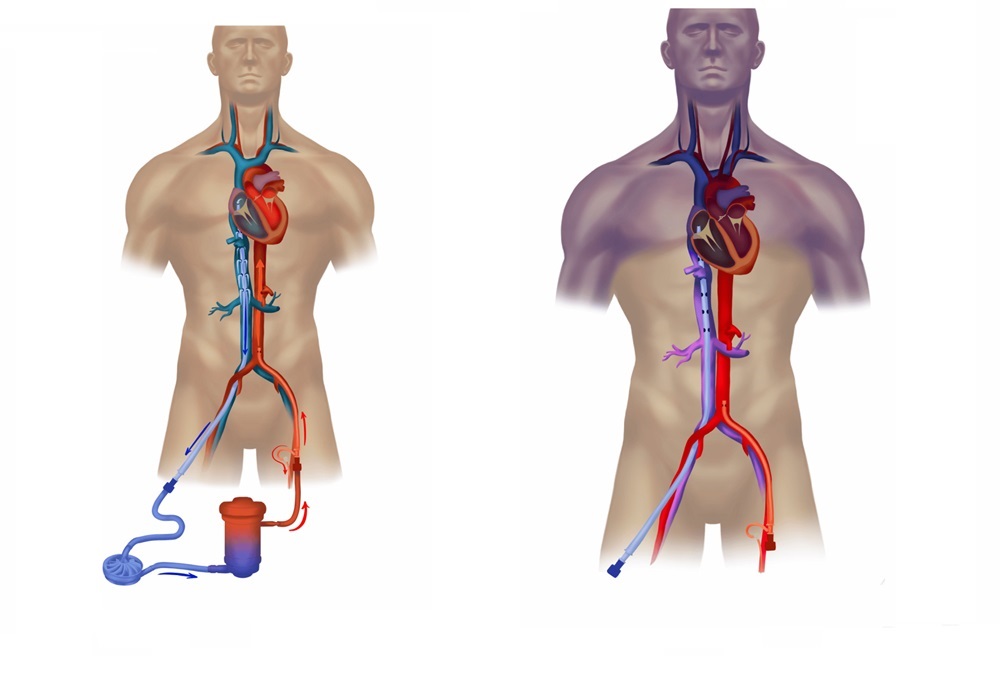 Extracorporeal Membrane Oxygenation (ECMO) Market Size, Growth and Share Forecasted to Grow 4-6% from 2024 to 2029