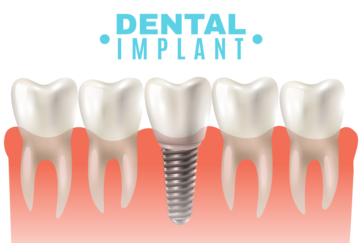 Global Dental Implants Market