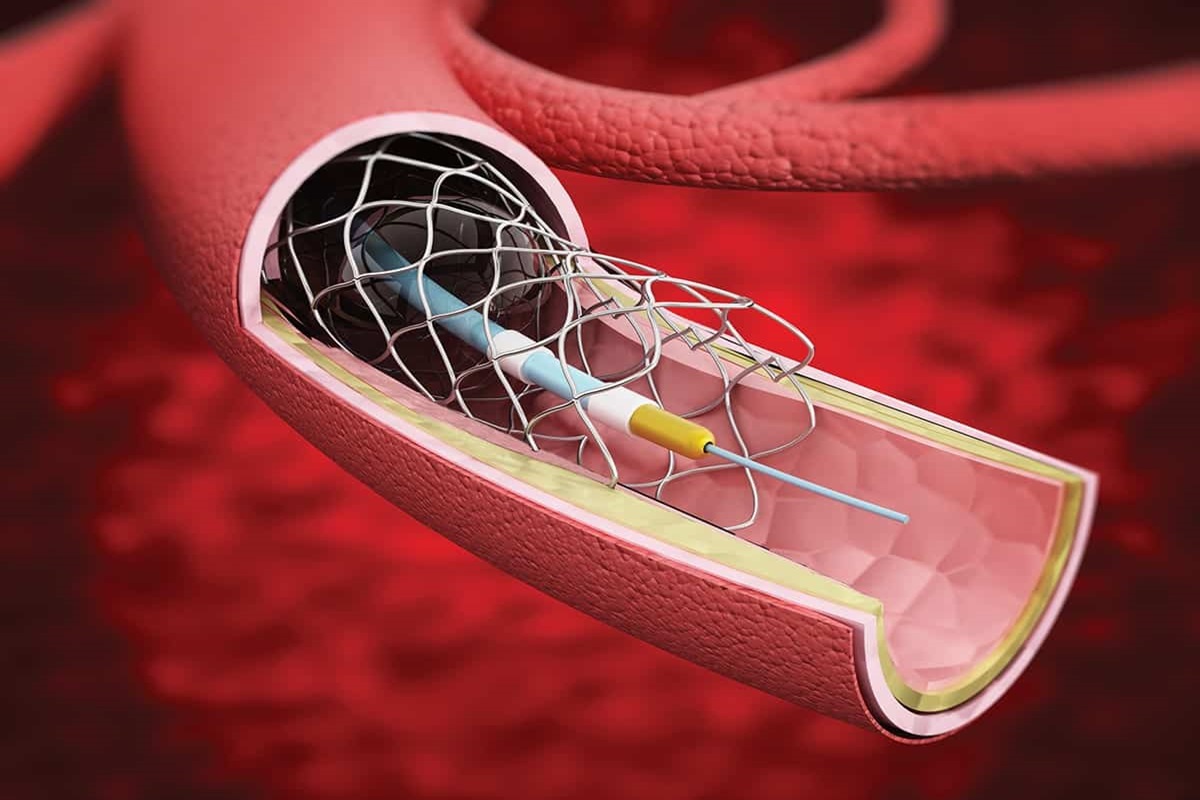 Global Vascular Stents Market