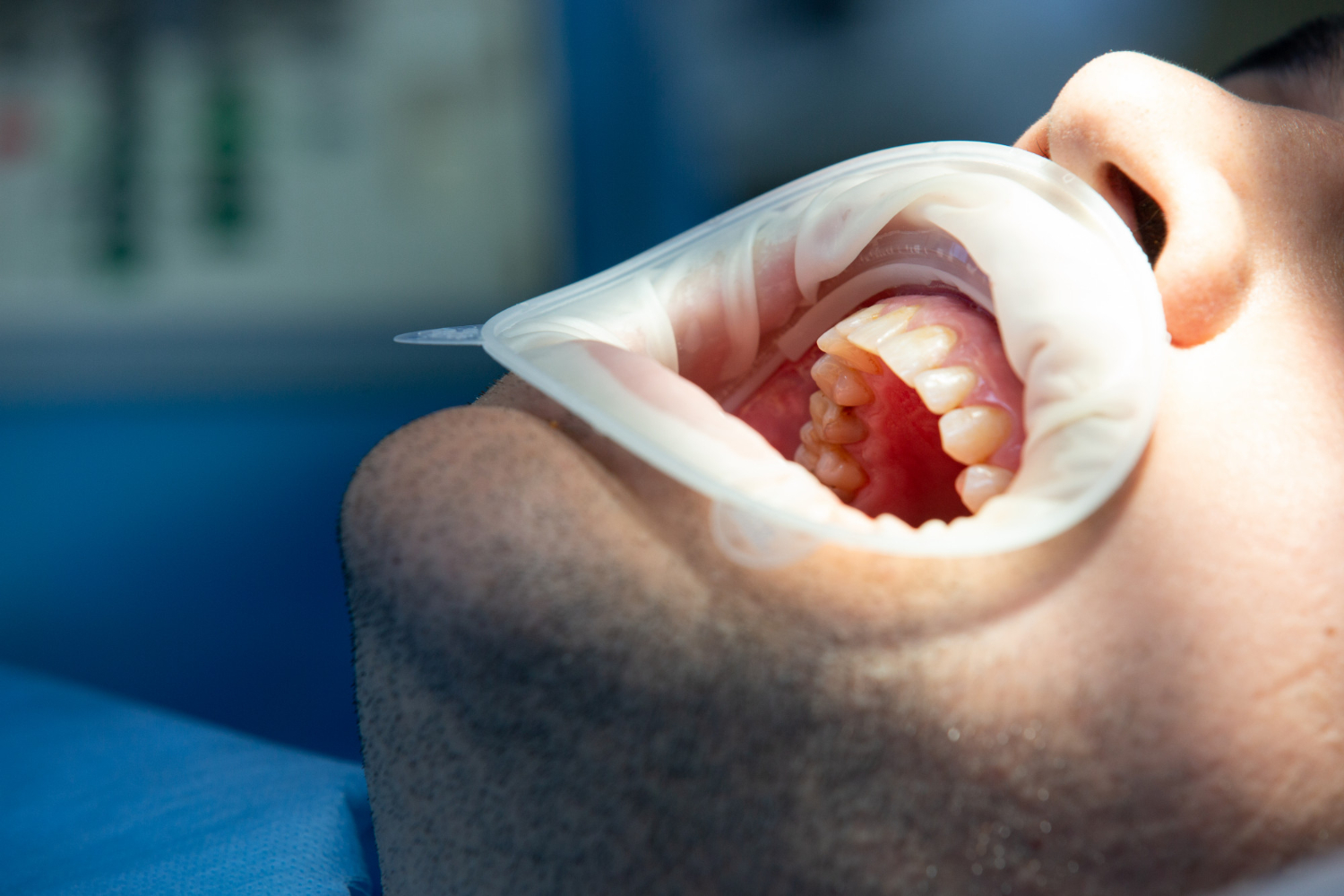 Dental Flap Surgery